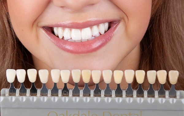 What You Should Know About Teeth Whitening